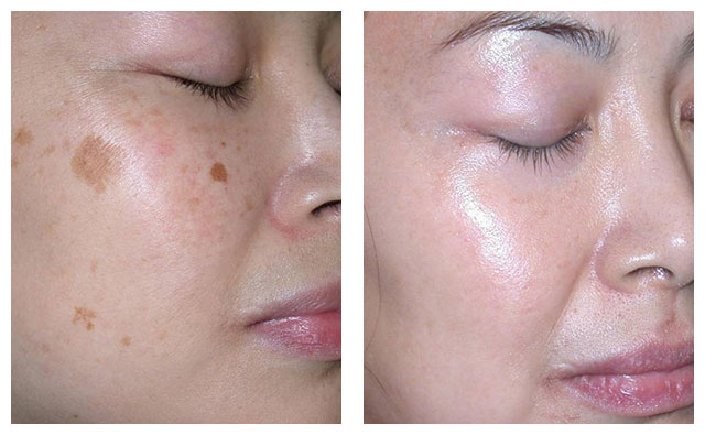 Pigmentation removal